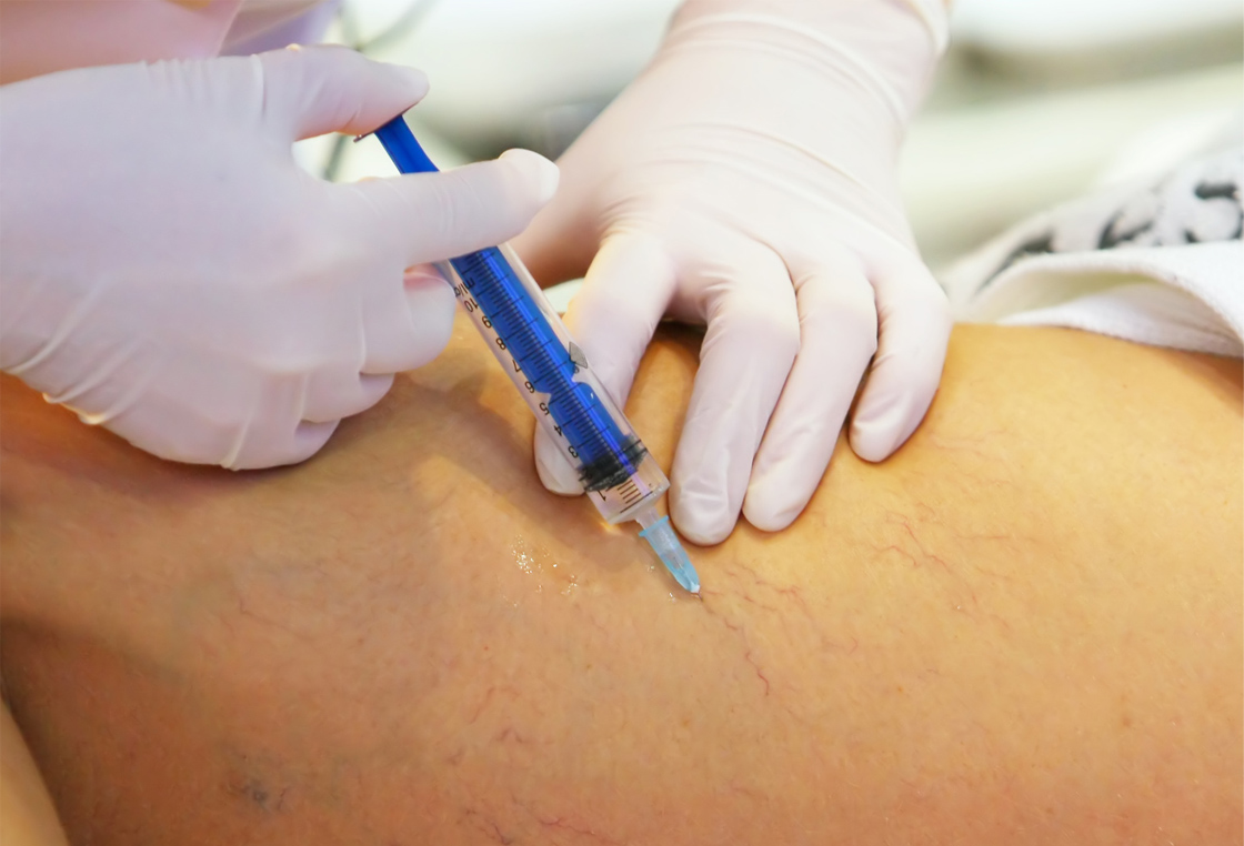 como-funciona-a-escleroterapia-para-o-tratamento-de-varizes