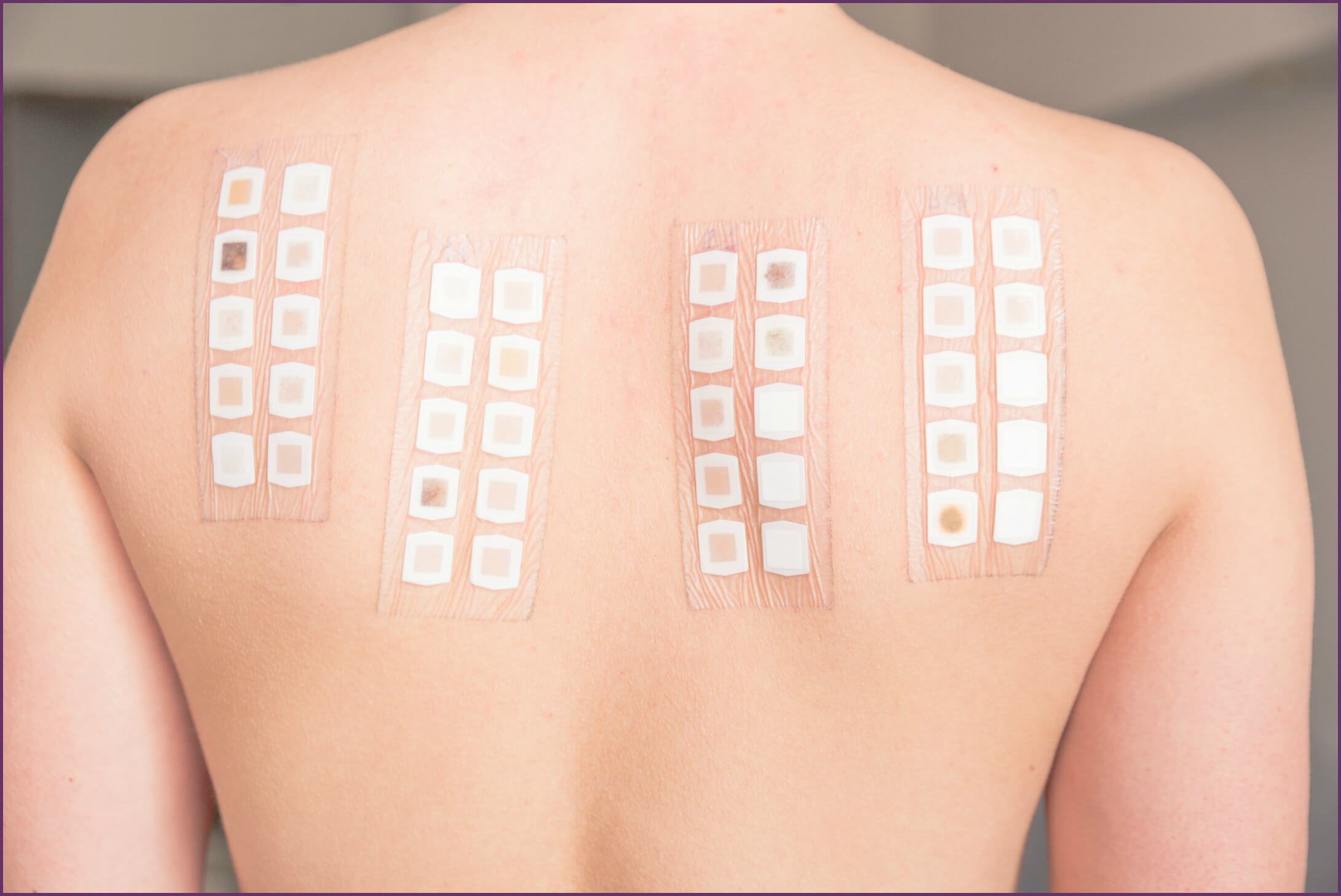 Patch Test: conheça a importância do teste de contato no diagnóstico da dermatite