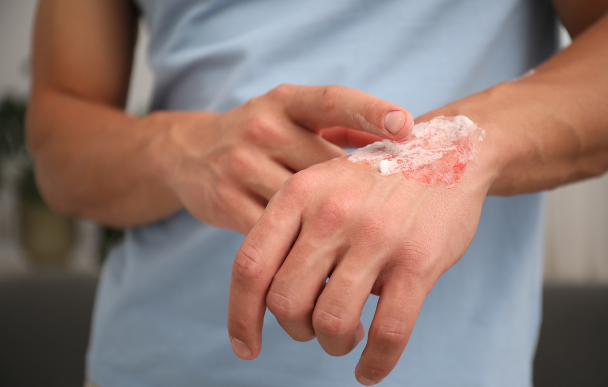 espirrou-oleo-quente-na-pele-o-que-passar-na-queimadura-e-o-que-nunca-usar