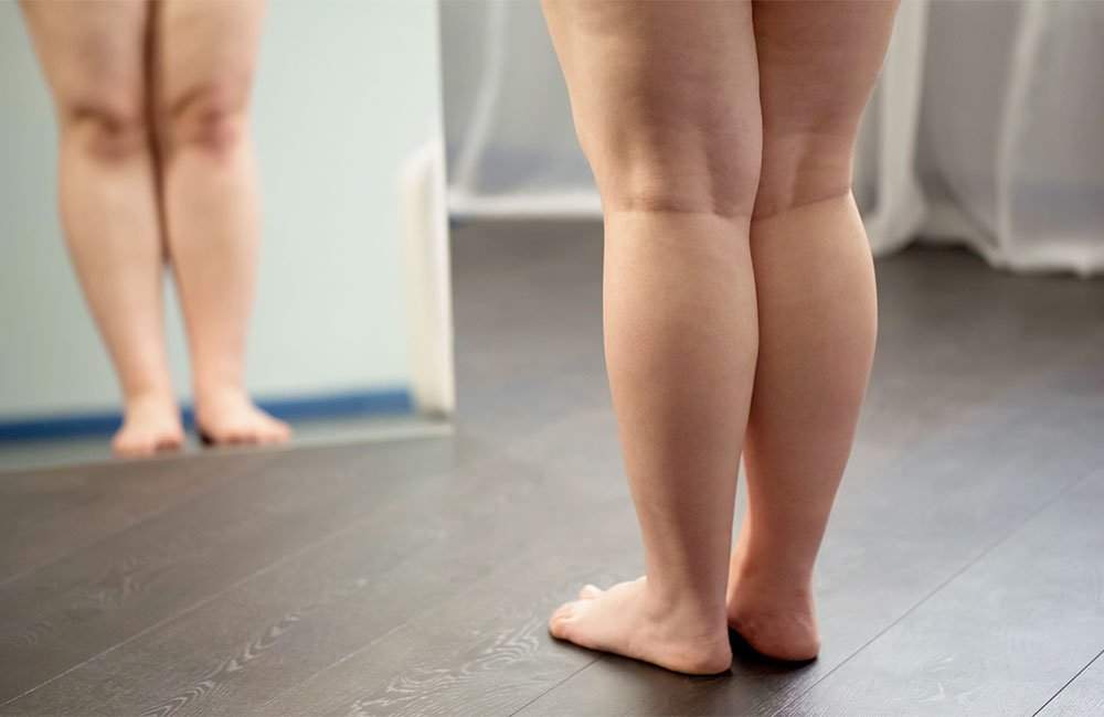 lipedema-e-o-mesmo-que-obesidade-clinica-vitta